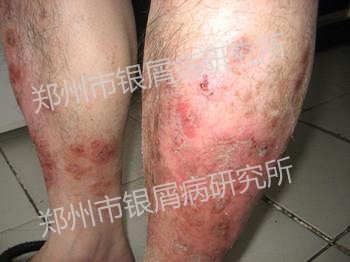 症状轻治就得快,症状重就治得慢吗?